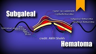 Subgaleal Hematoma [upl. by Rehteh576]