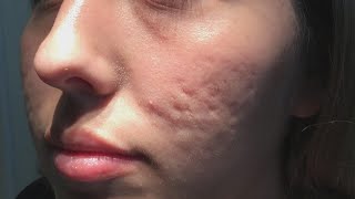 Does This New Procedure Clear up Acne Scars [upl. by Ibor]