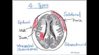 Intracranial Bleed  Part 1 [upl. by Gurney]