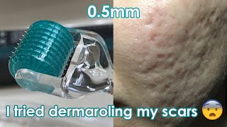 I tried dermarolling my ACNE SCARS  Demo  Review [upl. by Chor295]