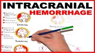 Caput Succedaneum V Cephalohematoma  a comprehensive explanation [upl. by Elleuqram]