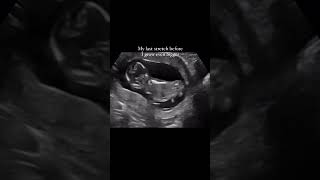 Ultrasound scan In Pregnancy [upl. by Aienahs]