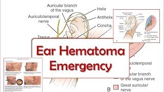 Epidural and Subdural Hematoma [upl. by Zolly16]