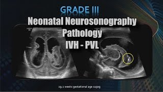 Ear Hematoma Emergency [upl. by Ydnal]